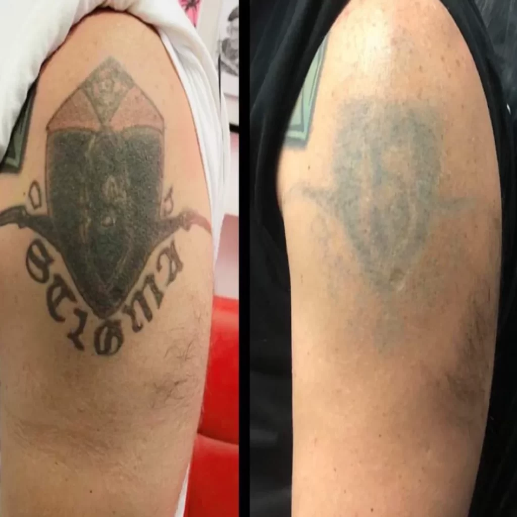 Melbourne tattoo removal