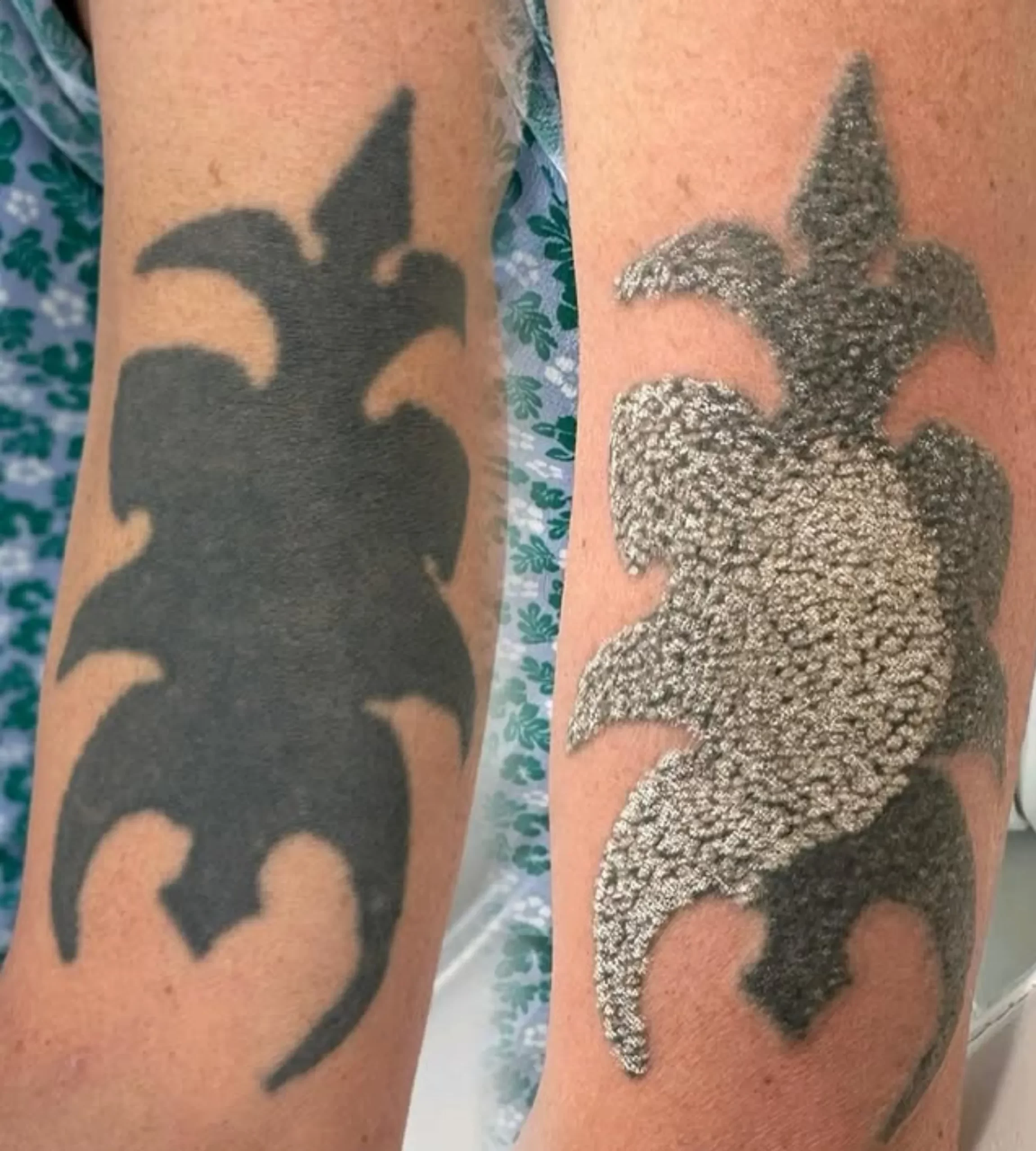 tattoo fading without laser