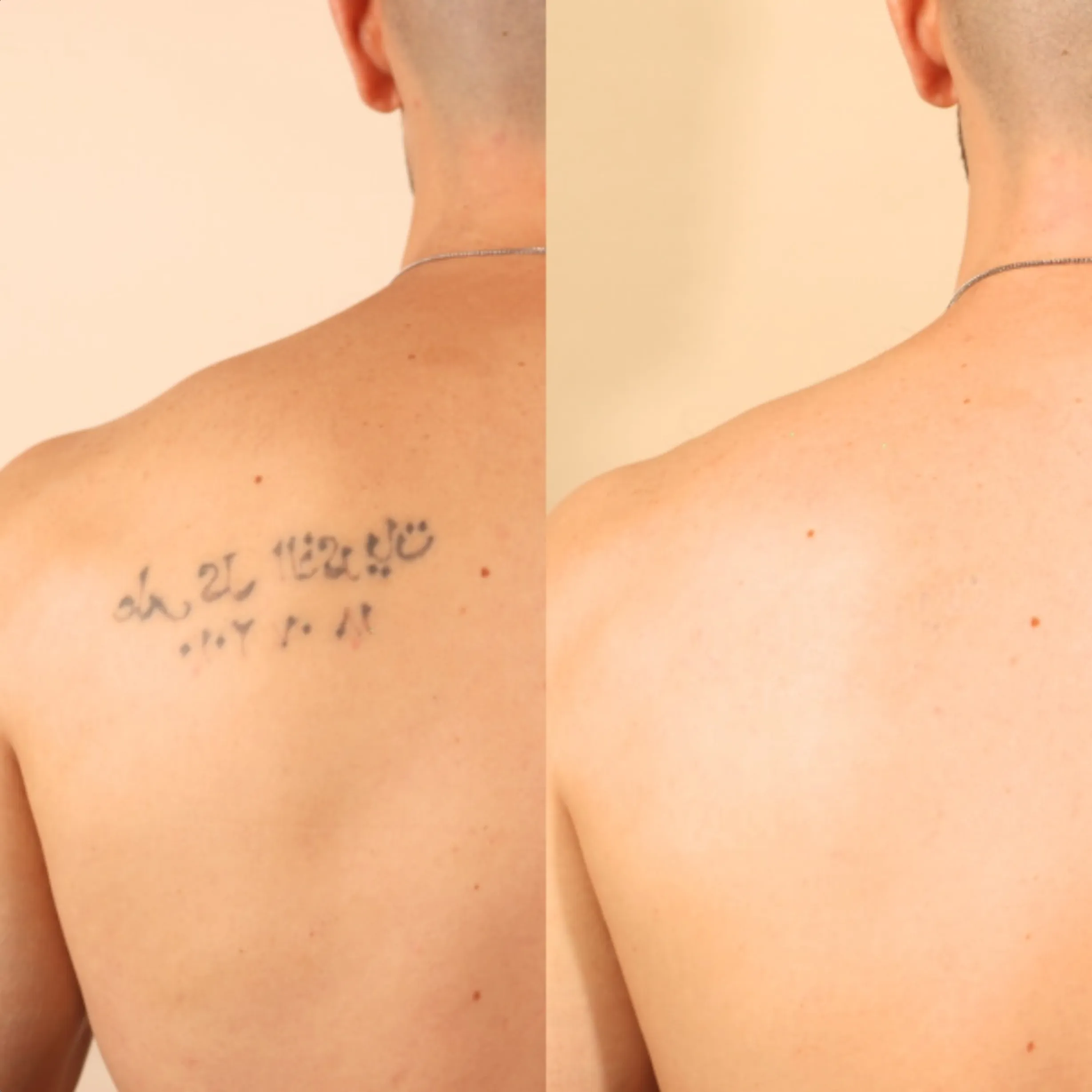 saline vs laser tattoo removal
