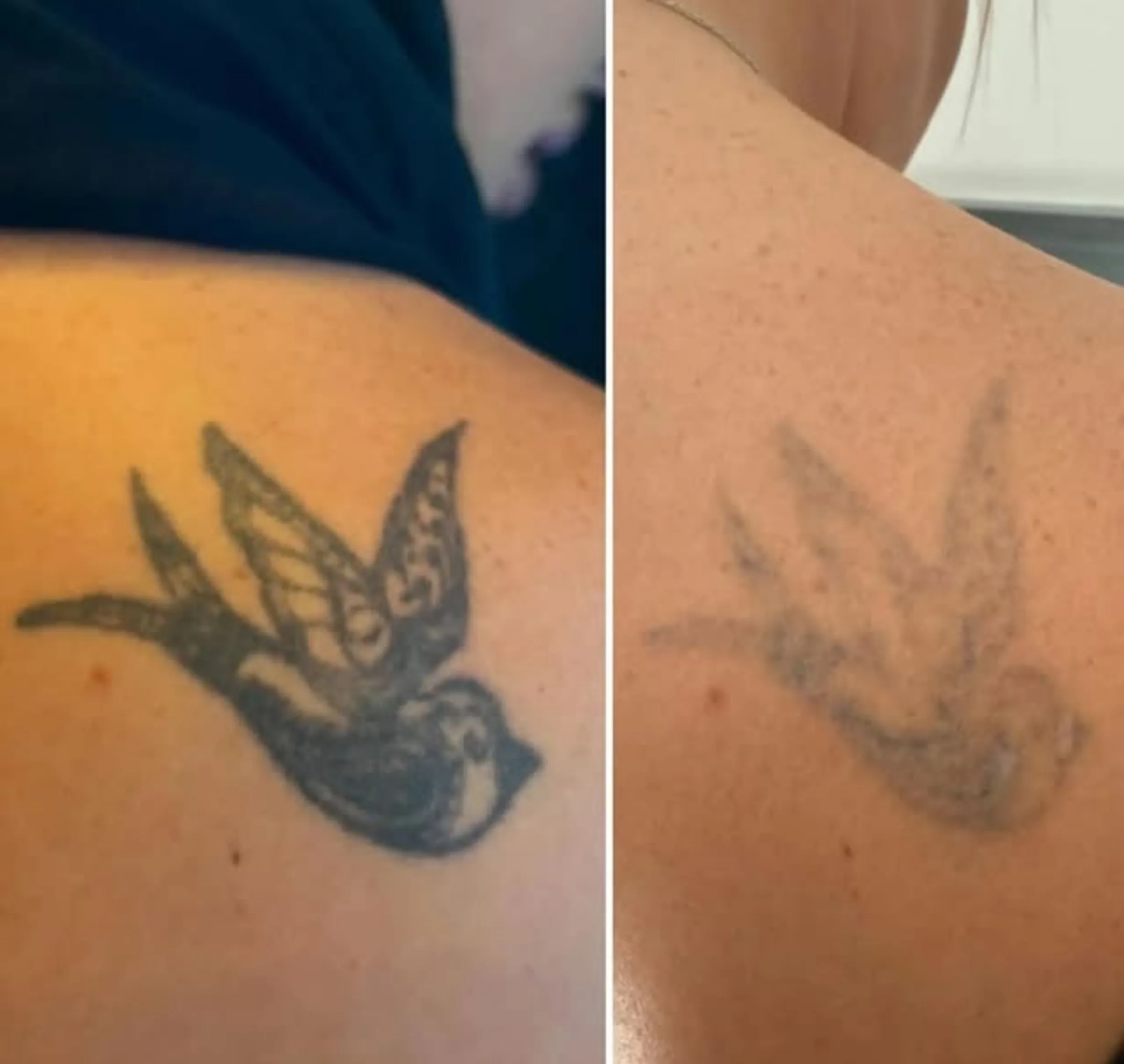trichloroacetic acid tattoo removal