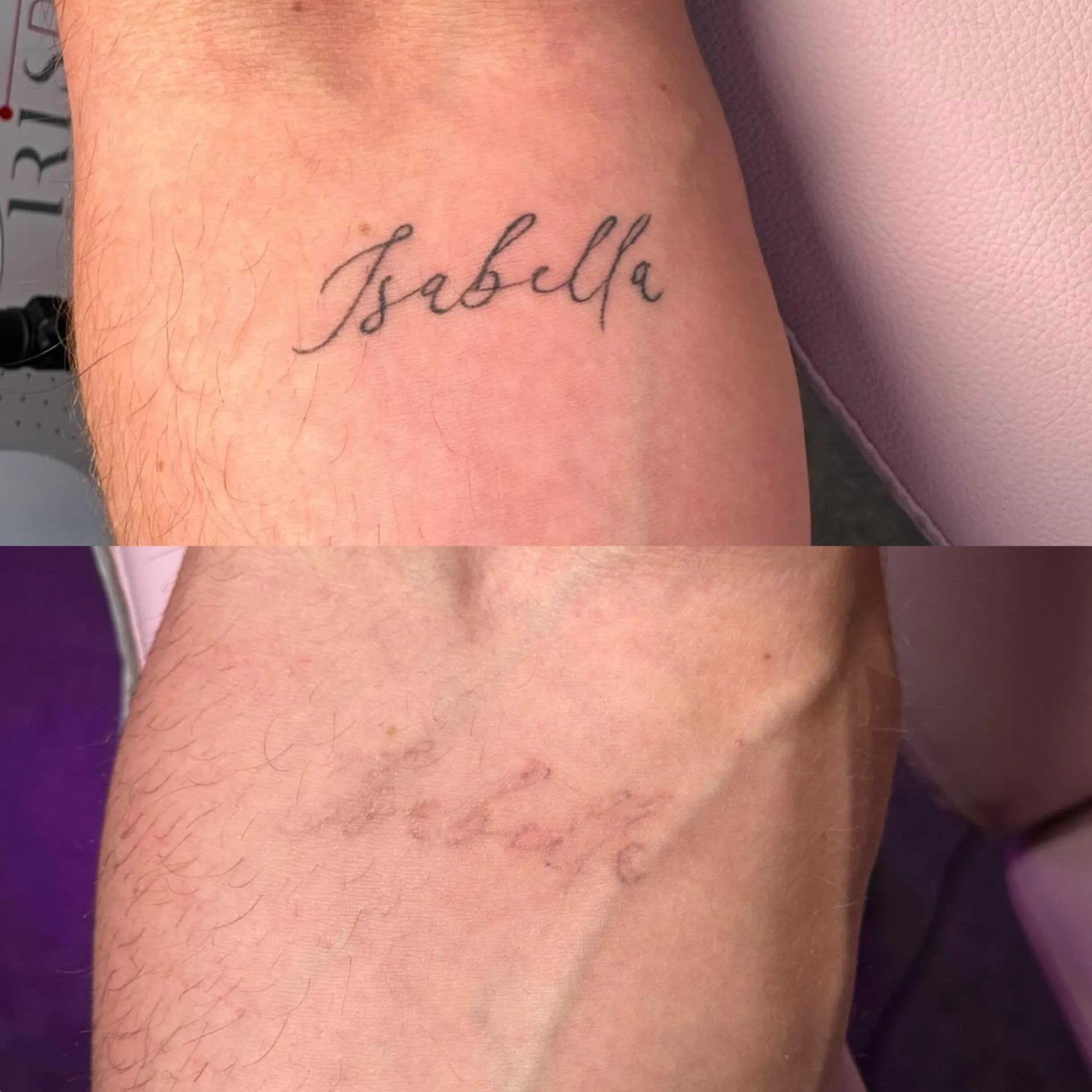 alternative to tattoo removal cream