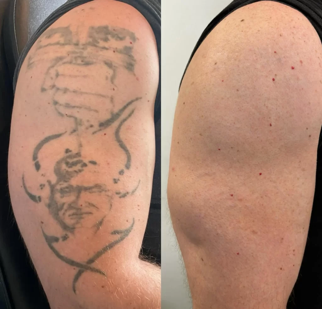 Tattoo Removal Creams