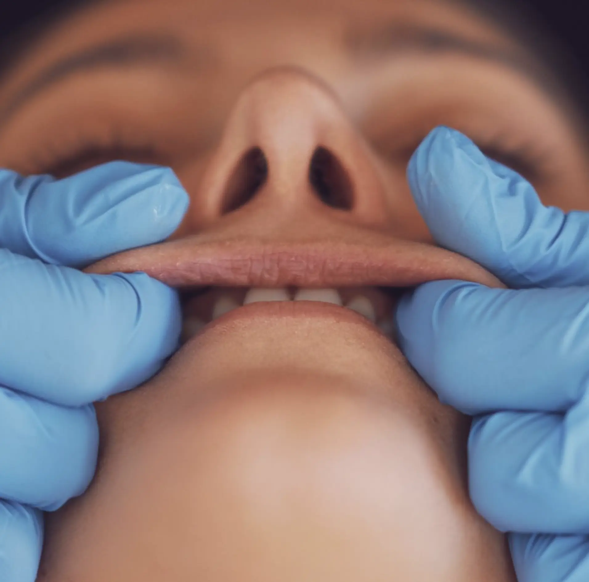 buccal massage before and after