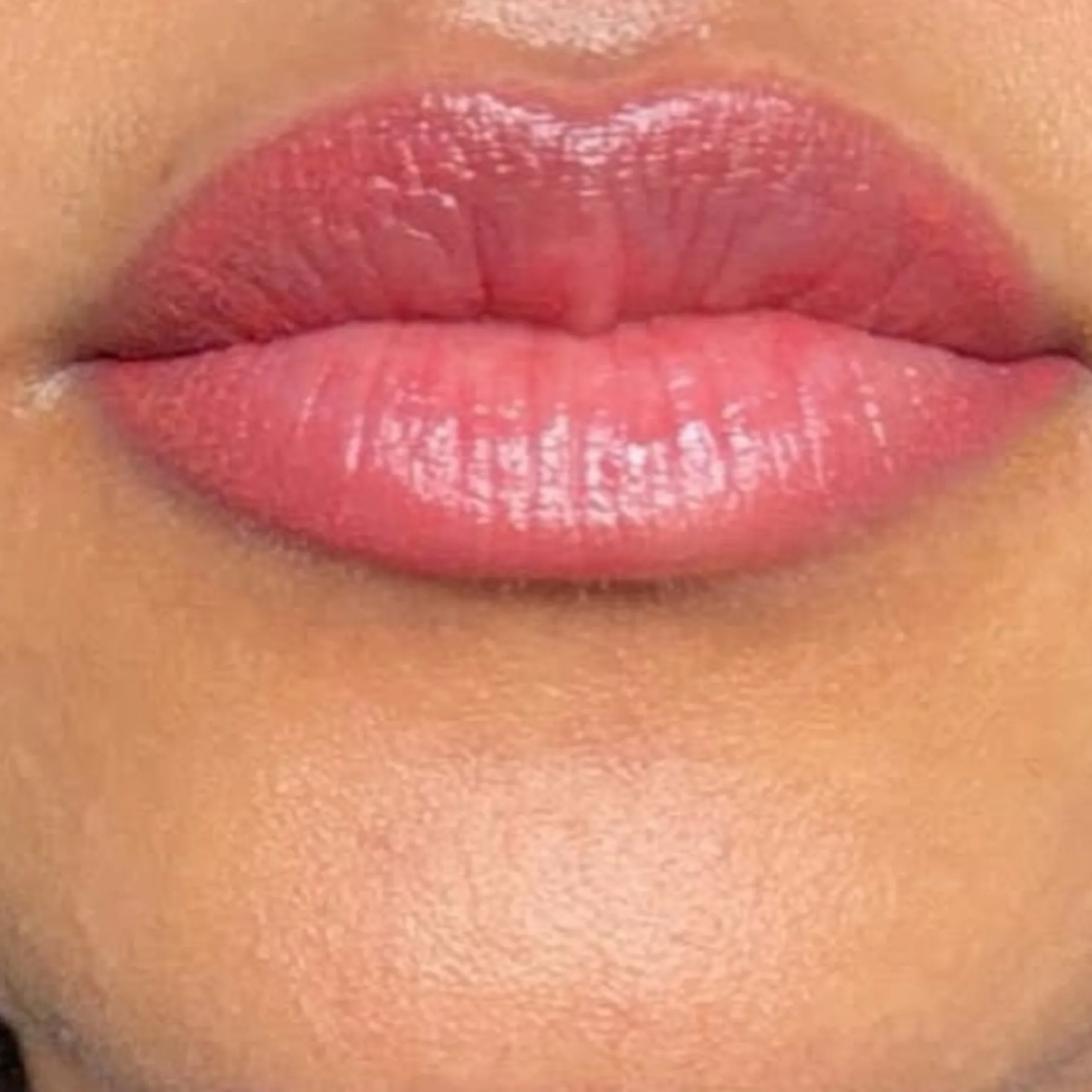lip neutralisation laser treatment session